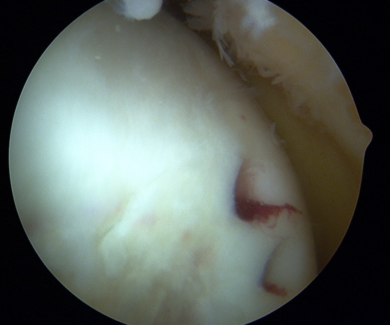 Mosaicplasty Harvest Site 2